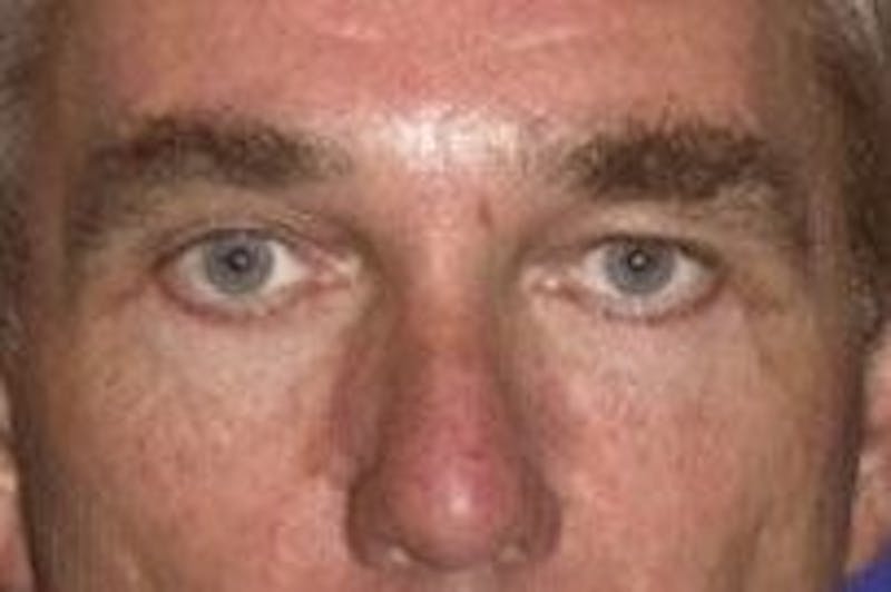 Blepharoplasty Before & After Gallery - Patient 354108 - Image 2