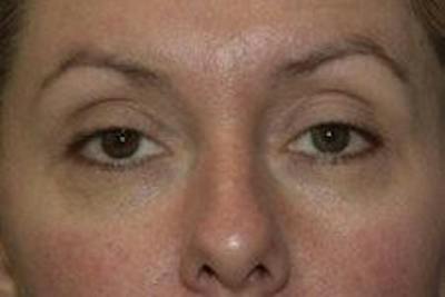 Blepharoplasty Before & After Gallery - Patient 196317 - Image 1