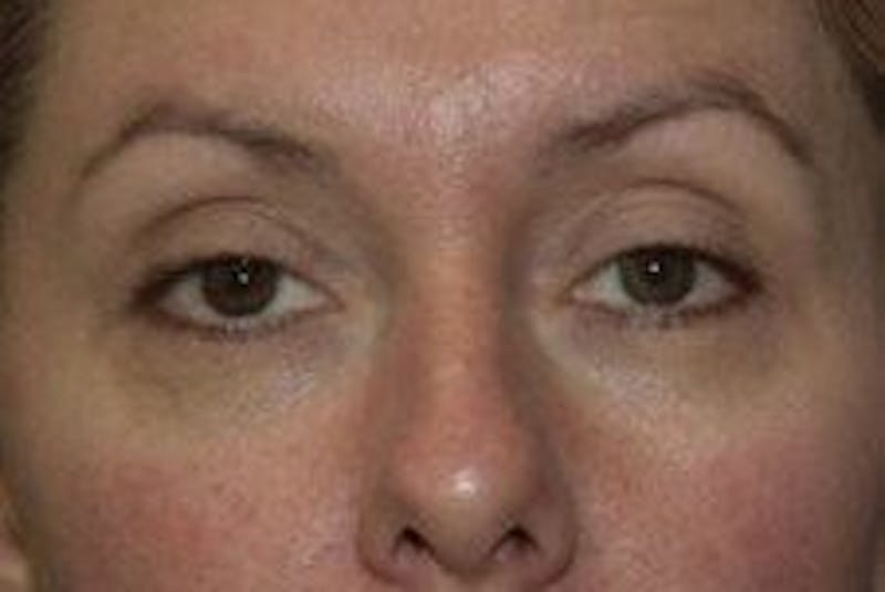 Blepharoplasty Before & After Gallery - Patient 196317 - Image 1