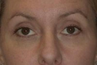 Blepharoplasty Before & After Gallery - Patient 196317 - Image 2