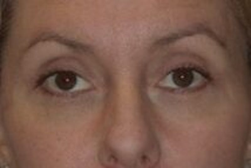 Blepharoplasty Before & After Gallery - Patient 196317 - Image 2