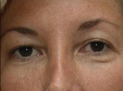 Blepharoplasty Before & After Gallery - Patient 118633 - Image 1