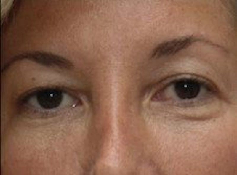 Blepharoplasty Before & After Gallery - Patient 118633 - Image 1