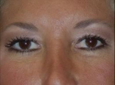 Blepharoplasty Before & After Gallery - Patient 118633 - Image 2