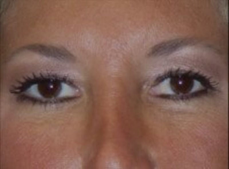 Blepharoplasty Before & After Gallery - Patient 118633 - Image 2