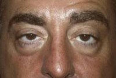 Blepharoplasty Before & After Gallery - Patient 366704 - Image 1