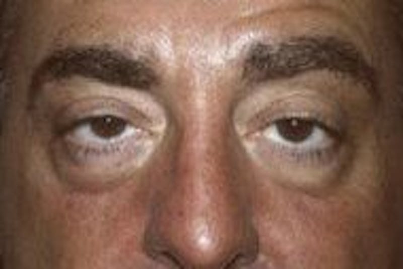 Blepharoplasty Before & After Gallery - Patient 366704 - Image 1