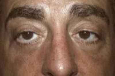 Blepharoplasty Before & After Gallery - Patient 366704 - Image 2