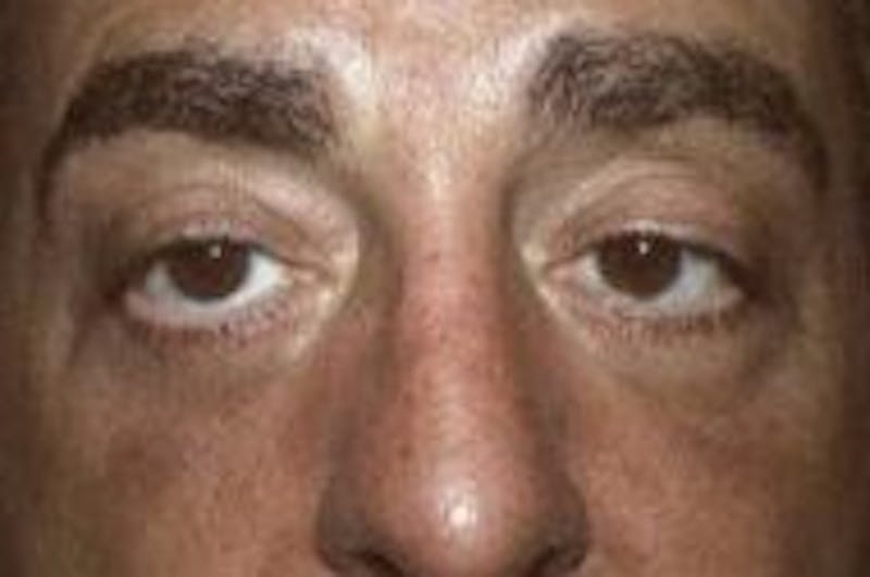 Blepharoplasty Before & After Gallery - Patient 366704 - Image 2
