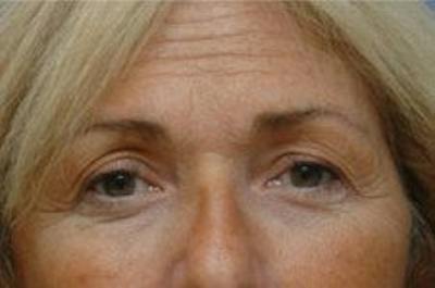 Blepharoplasty Before & After Gallery - Patient 382299 - Image 1