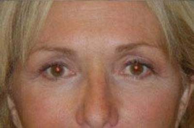 Blepharoplasty Before & After Gallery - Patient 382299 - Image 2