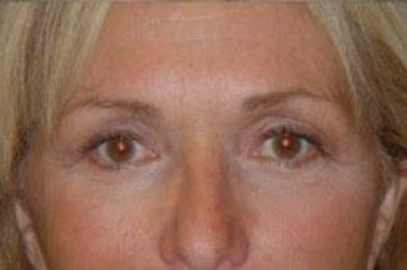 Blepharoplasty Before & After Gallery - Patient 382299 - Image 2