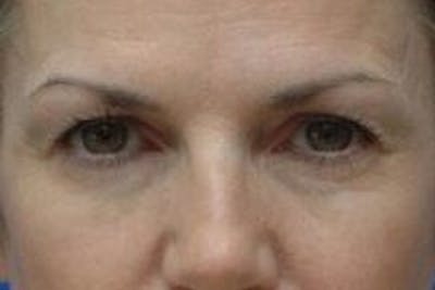 Blepharoplasty Before & After Gallery - Patient 338880 - Image 1