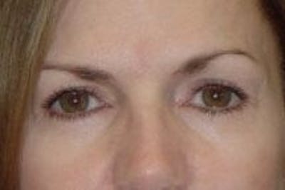 Blepharoplasty Before & After Gallery - Patient 338880 - Image 2