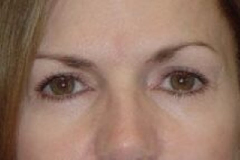 Blepharoplasty Before & After Gallery - Patient 338880 - Image 2
