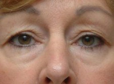 Blepharoplasty Before & After Gallery - Patient 269068 - Image 1
