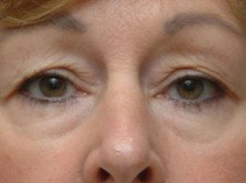 Blepharoplasty Before & After Gallery - Patient 269068 - Image 1
