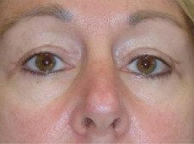 Blepharoplasty Before & After Gallery - Patient 269068 - Image 2