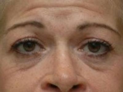 Blepharoplasty Before & After Gallery - Patient 320119 - Image 1