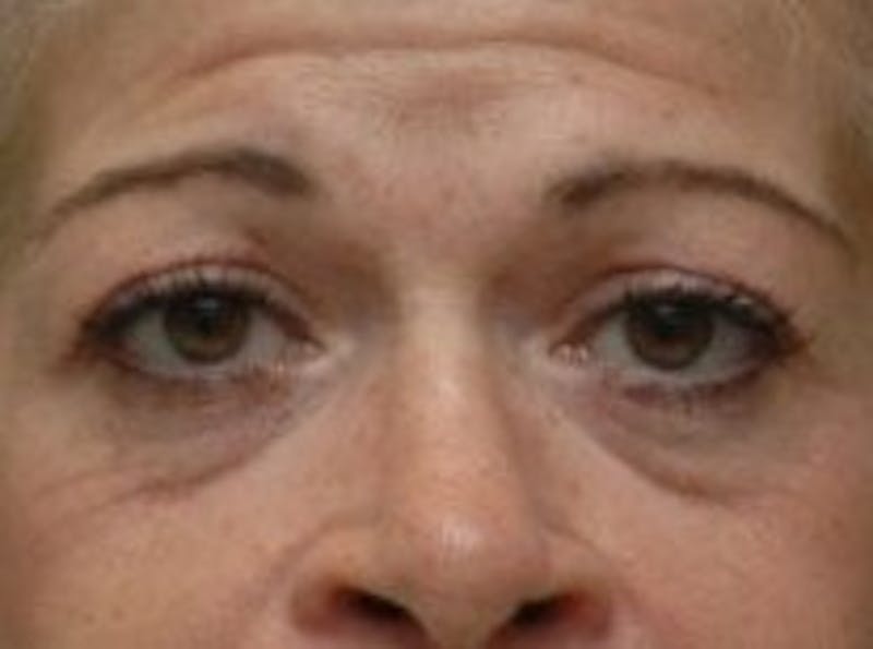 Blepharoplasty Before & After Gallery - Patient 320119 - Image 1