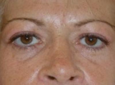 Blepharoplasty Before & After Gallery - Patient 320119 - Image 2