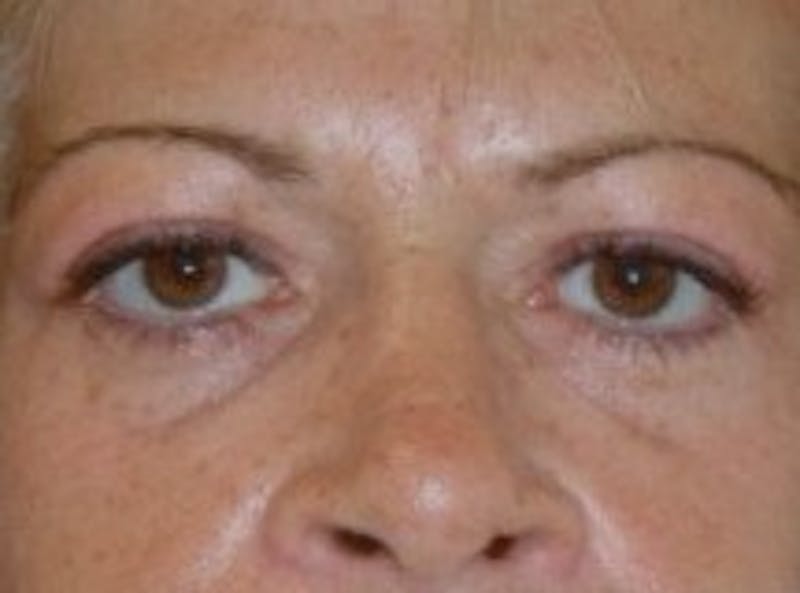 Blepharoplasty Before & After Gallery - Patient 320119 - Image 2