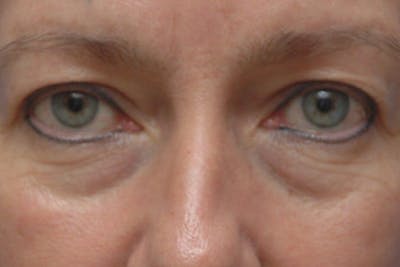 Blepharoplasty Before & After Gallery - Patient 304099 - Image 1