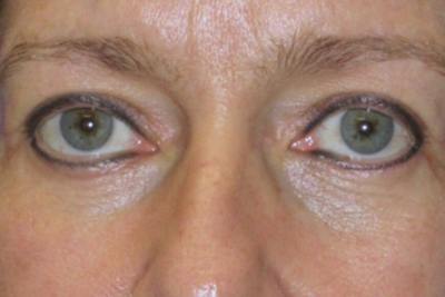 Blepharoplasty Before & After Gallery - Patient 304099 - Image 2