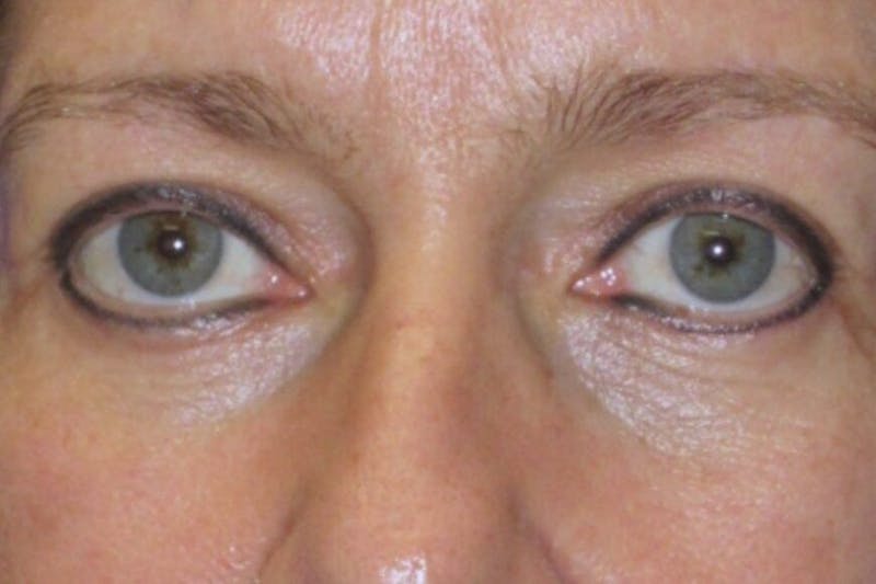 Blepharoplasty Before & After Gallery - Patient 304099 - Image 2