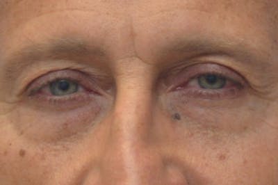 Blepharoplasty Before & After Gallery - Patient 206686 - Image 1
