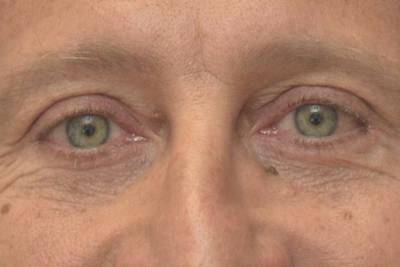 Blepharoplasty Before & After Gallery - Patient 206686 - Image 2