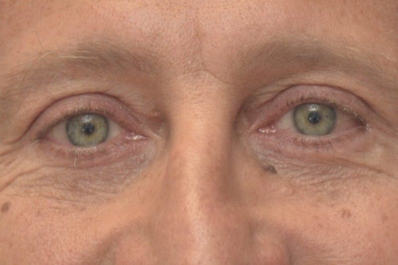 Blepharoplasty Before & After Gallery - Patient 206686 - Image 2