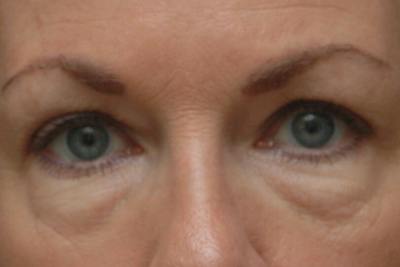 Blepharoplasty Before & After Gallery - Patient 151424 - Image 1