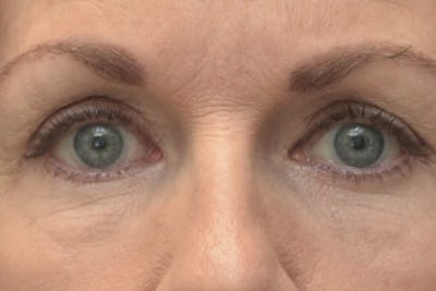 Blepharoplasty Before & After Gallery - Patient 151424 - Image 2