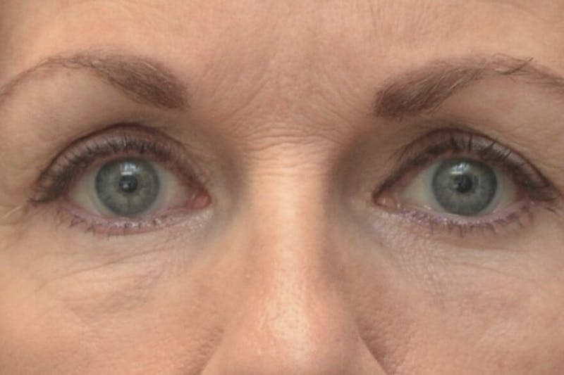 Blepharoplasty Before & After Gallery - Patient 151424 - Image 2