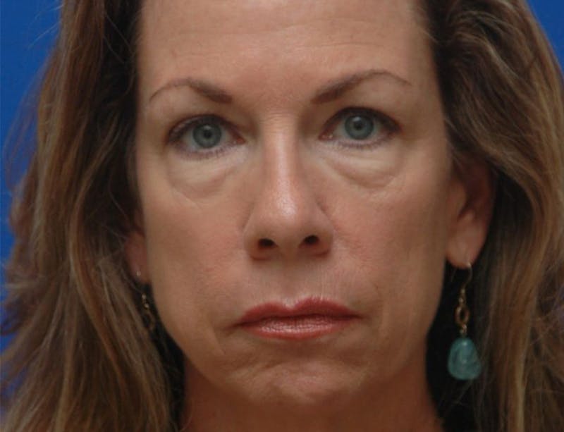 Blepharoplasty Before & After Gallery - Patient 151424 - Image 3