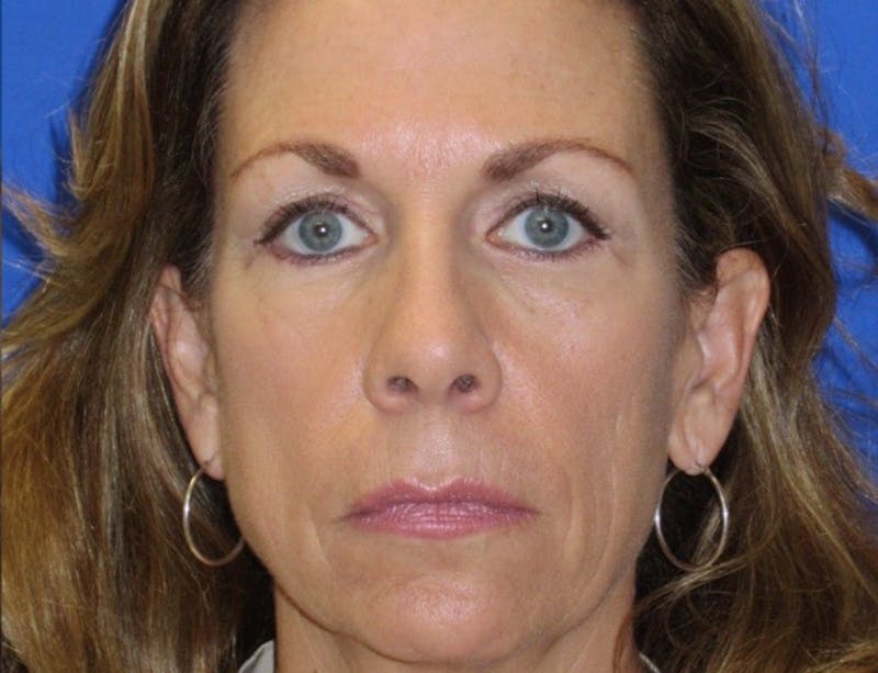 Blepharoplasty Before & After Gallery - Patient 151424 - Image 4