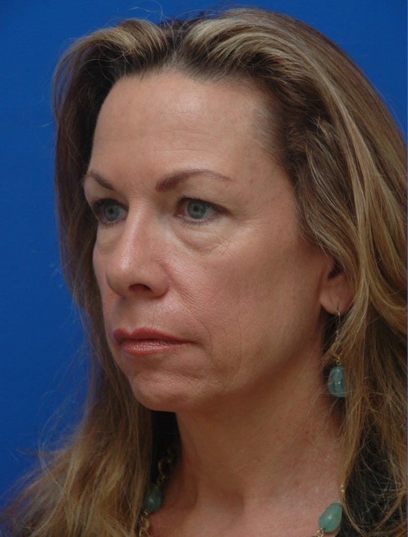Blepharoplasty Before & After Gallery - Patient 151424 - Image 5