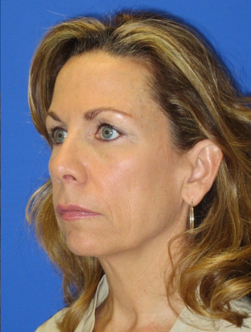 Blepharoplasty Before & After Gallery - Patient 151424 - Image 6