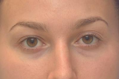 Blepharoplasty Before & After Gallery - Patient 269820 - Image 1