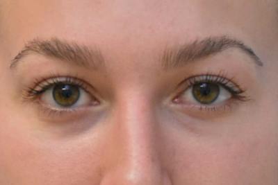 Blepharoplasty Before & After Gallery - Patient 269820 - Image 2