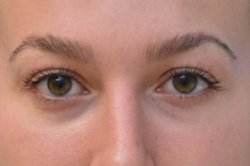 Blepharoplasty Before & After Gallery - Patient 269820 - Image 2