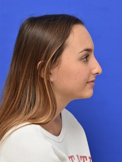 Nonsurgical Rhinoplasty Before & After Gallery - Patient 146013 - Image 1
