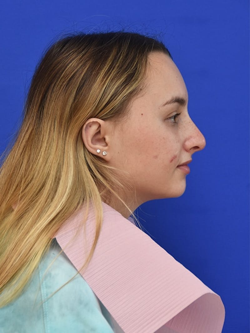 Nonsurgical Rhinoplasty Before & After Gallery - Patient 146013 - Image 2