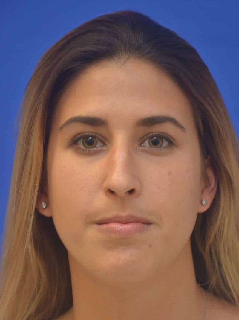 Nonsurgical Rhinoplasty Before & After Gallery - Patient 765670 - Image 1