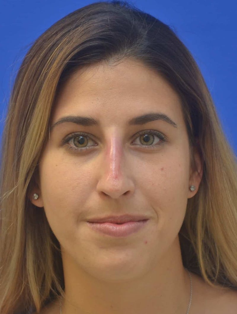 Nonsurgical Rhinoplasty Before & After Gallery - Patient 765670 - Image 2