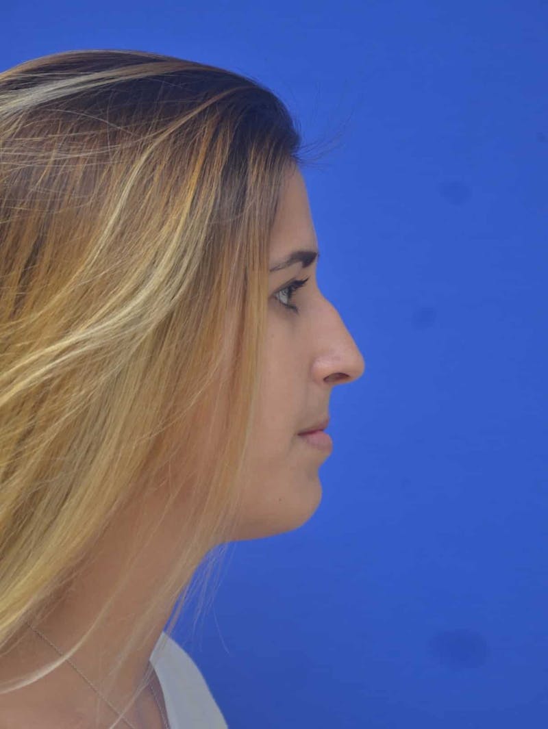 Nonsurgical Rhinoplasty Before & After Gallery - Patient 765670 - Image 3