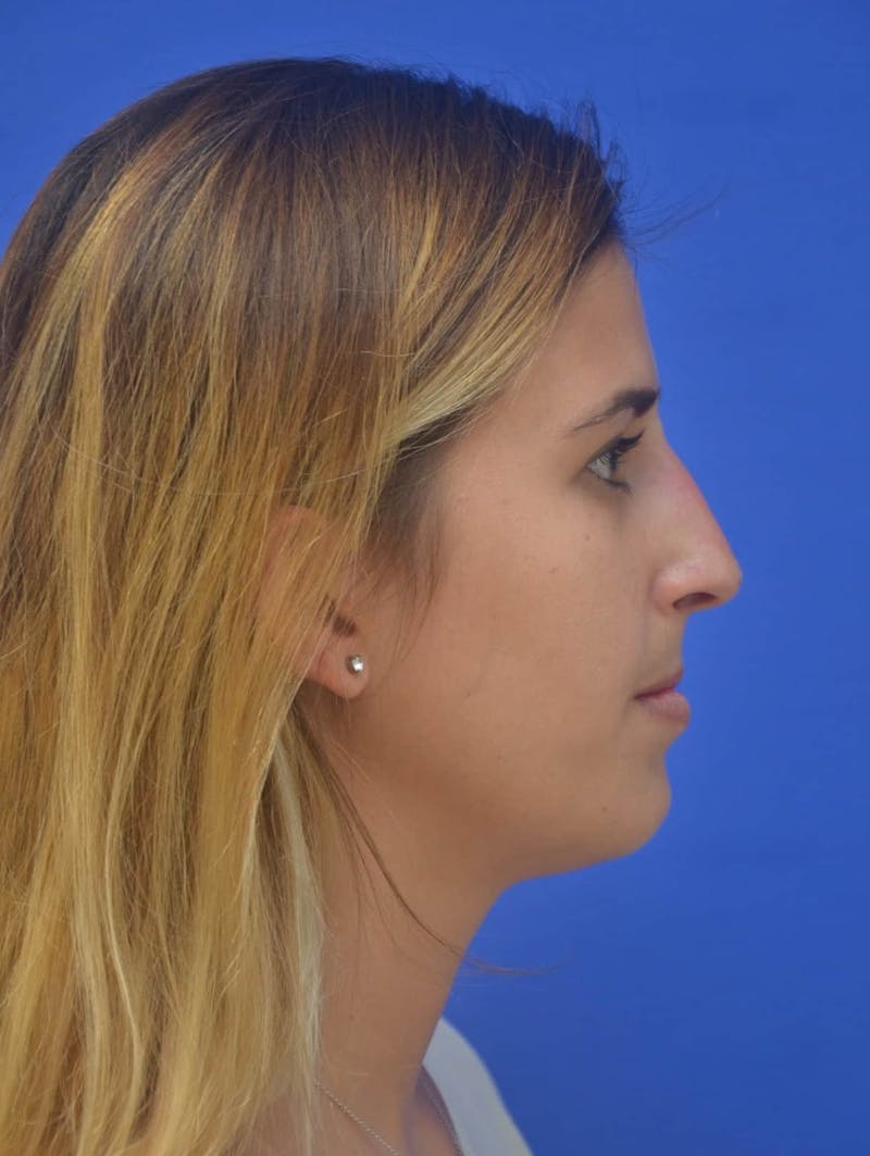 Nonsurgical Rhinoplasty Before & After Gallery - Patient 765670 - Image 4