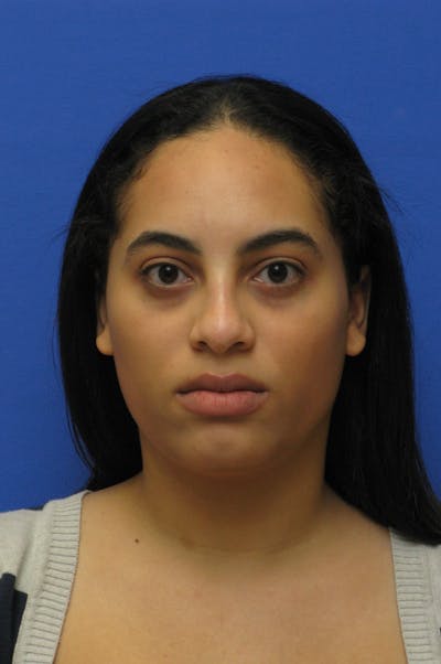 Nonsurgical Rhinoplasty Before & After Gallery - Patient 127902 - Image 1