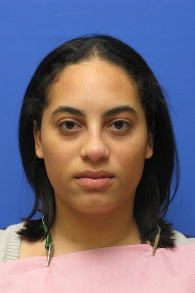 Nonsurgical Rhinoplasty Before & After Gallery - Patient 127902 - Image 2